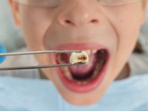 Best Same-Day Emergency Dentist in Schriever, LA